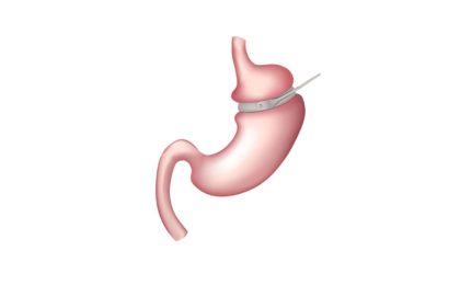 virtual gastric band weight loss graphic